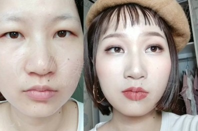 太原双眼皮整形手术医生推荐：弓军胜与刘晋元谁做的更好？