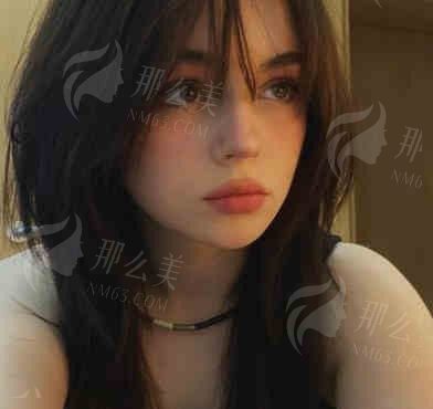丹东诗莉花美容院双眼皮价格表及案例展示，王秉政医生主刀！