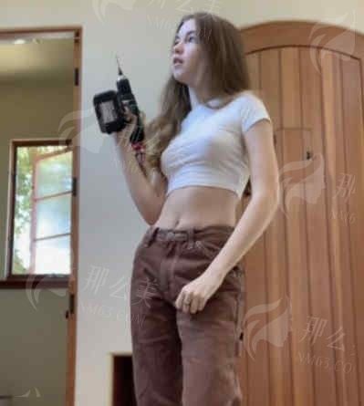万芸医生深圳抽脂案例详解：术后效果对比，专家技术点评，值得信赖吗？