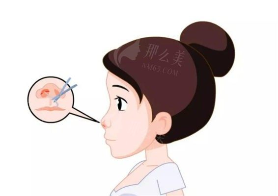 上海华美医院鼻部整形：叶丽萍、成建璋医生预约热度高，玻尿酸隆鼻3000元起