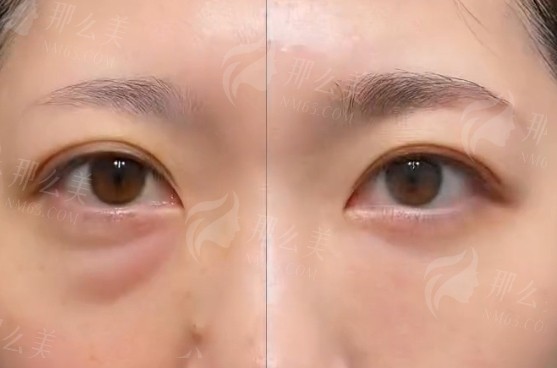 遵义祛眼袋医院医生排名有哪些？曝光这几家热门医院上榜