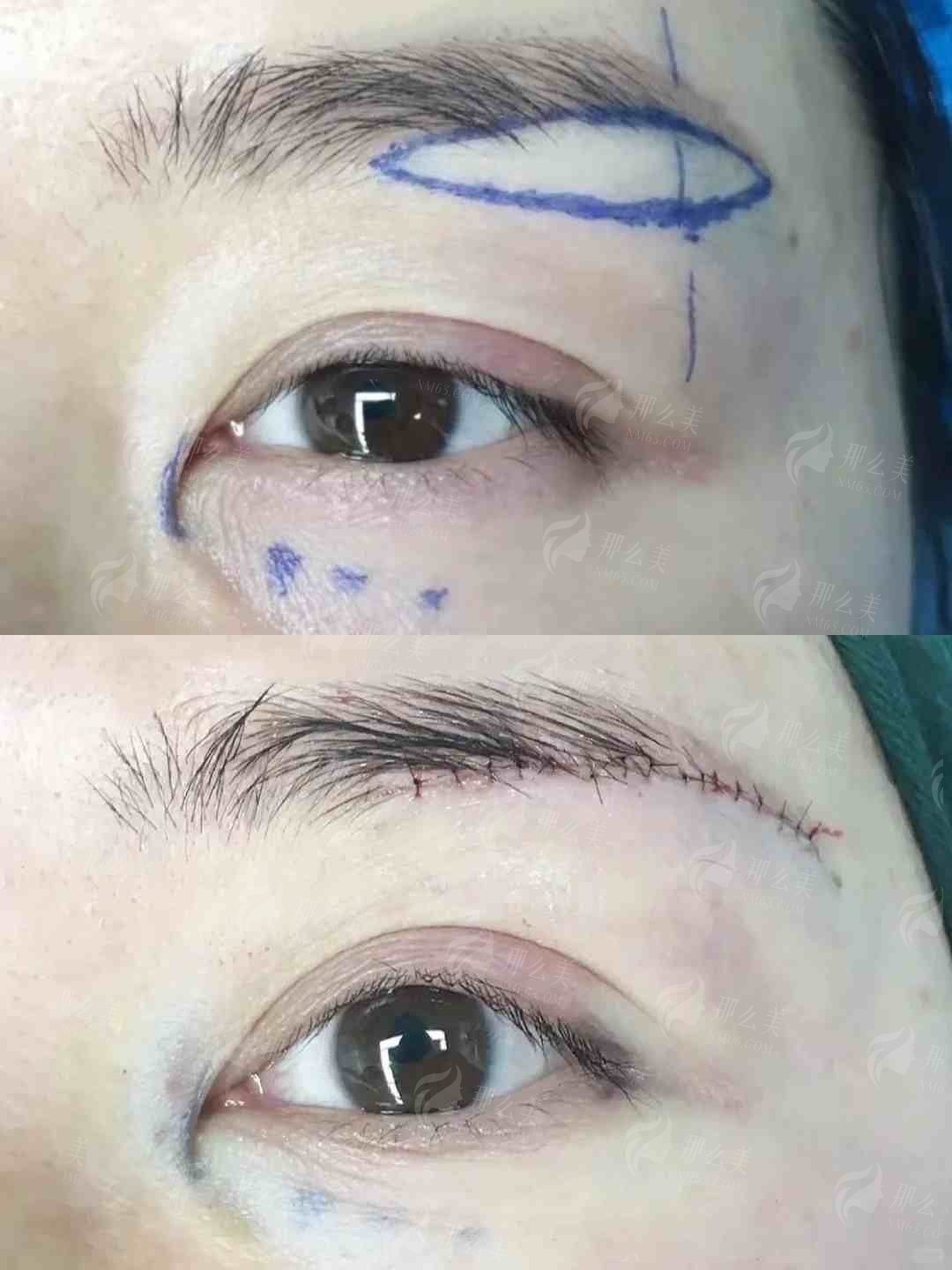 厦门欧菲整形医院切眉技术好不好？医院信息|价格表点评！