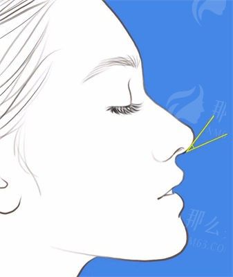 上海馥兰朵程超群医生整形技术怎么样？擅长鼻翼缩小/玻尿酸注射等-预约方式