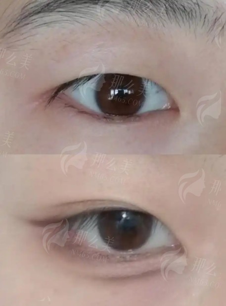 南京艺星哪个医生做眼部好？刘永杨、汪树杰、朱姗姗医生技术测评