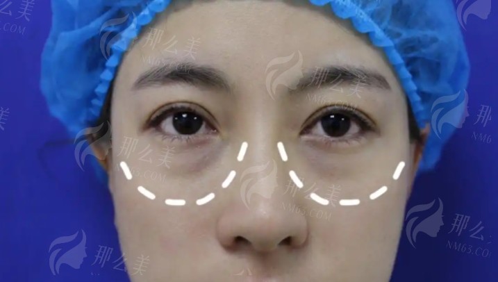 银川祛眼袋医院医生排名有哪些？严选这五家正规医院介绍