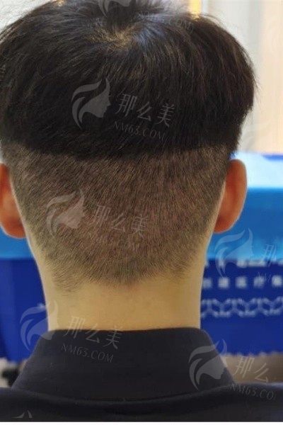 雍禾种植毛发价格对比：实惠可靠，反馈满意