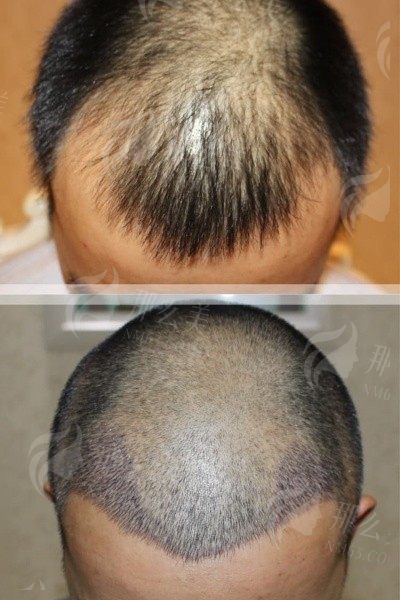 南通碧莲盛植发医院热门项目推荐：植发效果、恢复期、费用详解   