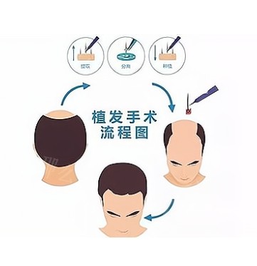 成都大麦微针植发医院怎么样？医院+医生介绍