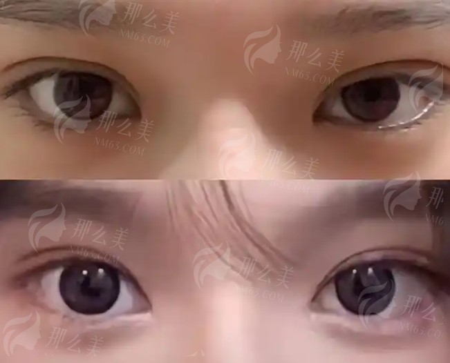 常州哪里修复双眼皮较好？top榜前五名单公布！收藏再看