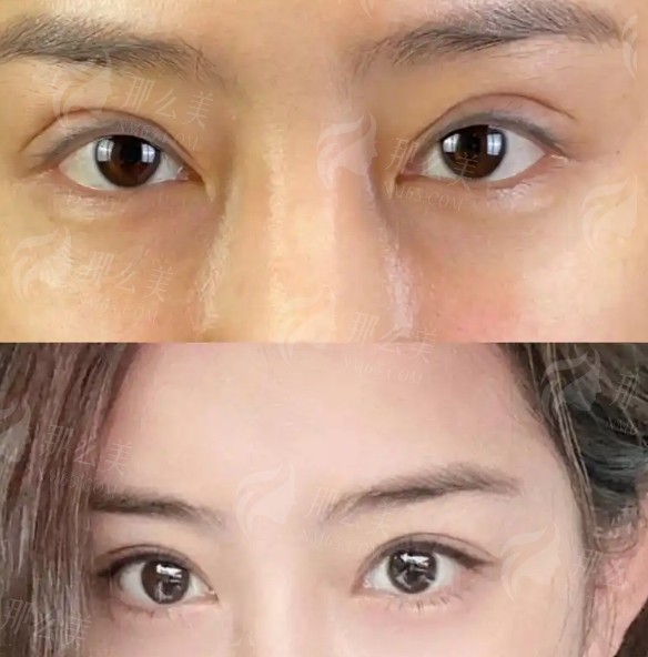 合肥做双眼皮的医院哪家好？这几家医院在当地很受欢迎！