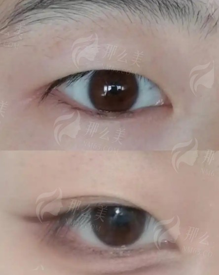 南昌做双眼皮手术哪家医院好？这五家机构技术卓越！