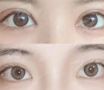 长沙美莱哪个医生做眼睛好？内附医院信息及项目介绍 