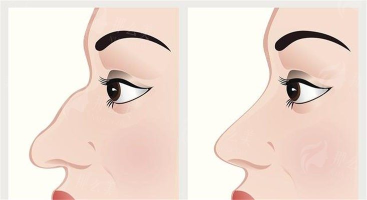 乌鲁木齐隆鼻专家排名前五：赵玉/腾万里/李艳霞是前三，新疆隆鼻价格表公开