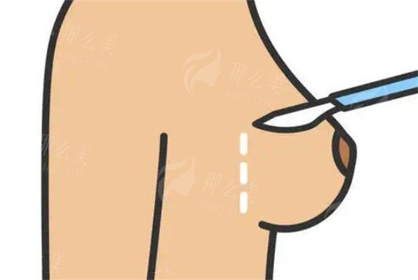北京美莱高超：实力派胸部整形医生-可做乳头内陷矫正/乳房下垂矫正