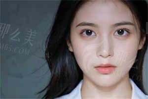 成都素美免费招募双眼皮案例是真的吗？附报名地址+预约方式