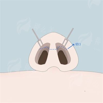上海乐原整形外科门诊简介-李建勋医生擅长鼻整形/面部轮廓打造-玻尿酸隆鼻价格1122元起