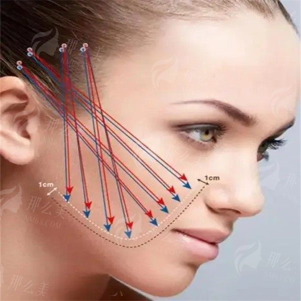 北京蒂凡妮王志坚医生拉皮怎么样？TCM高位组织复位提升术大提升