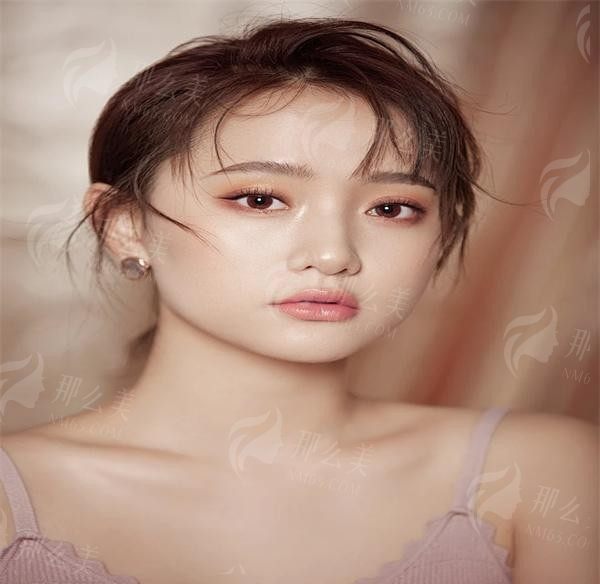 广州王娟医生双眼皮修复怎么样？小创口精细化剥离技术疤痕看不见，重视眼部动感美学