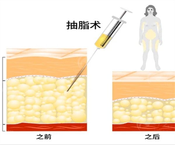 广州艺星邓晟华抽脂怎么样？蜂巢立体推进注射移植技术提高吸脂塑形，“减脂+塑形”一体化