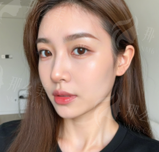 赣州田美整形黄成斌肋软骨综合隆鼻预约攻略 黄成斌隆鼻效果优势&地址公布