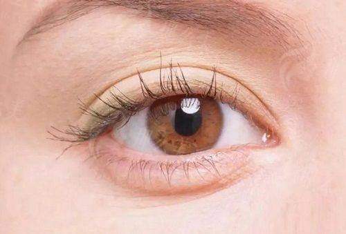 三、上海华 山医院丁志医生双眼皮真人实例大揭秘