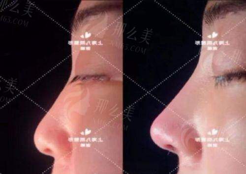 二、广州曙光肖强肋软骨隆鼻的三大核心技术