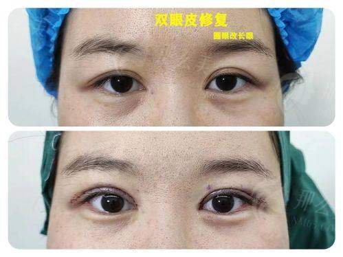 一、上海华 山医院丁志医生的双眼皮为什么这么火?