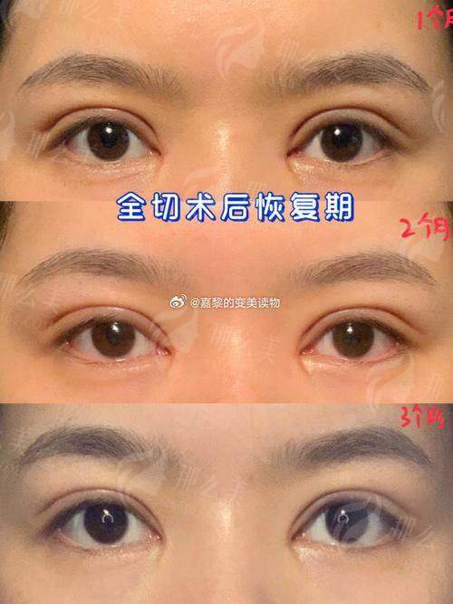 一、重庆眼部整形好医院怎么选？米兰柏羽时光整形实力解析