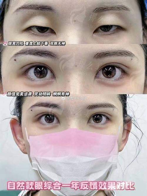 四、上海华 山医院丁志医生双眼皮怎么预约?