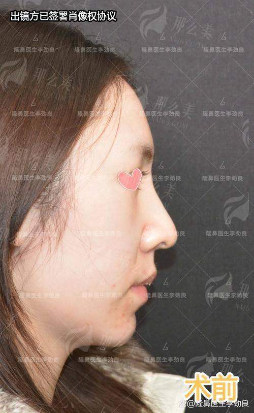 一、杭州清锴医疗李保锴院长隆鼻怎么样？