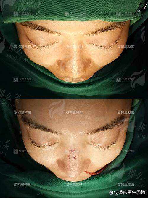 二、深圳宝丽李信锋鼻修复为什么这么厉害?三大核心技术解析