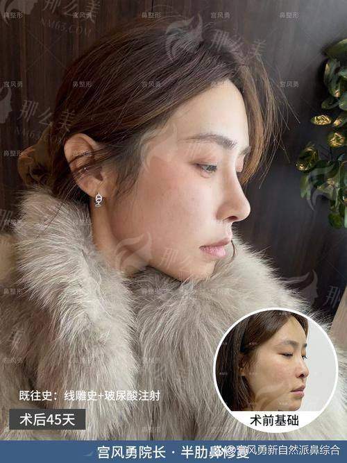 一、深圳宝丽李信锋鼻修复技术怎么样?看这些实例就知道