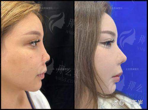 四、深圳宝丽李信锋鼻修复值得选吗?过来人这样说