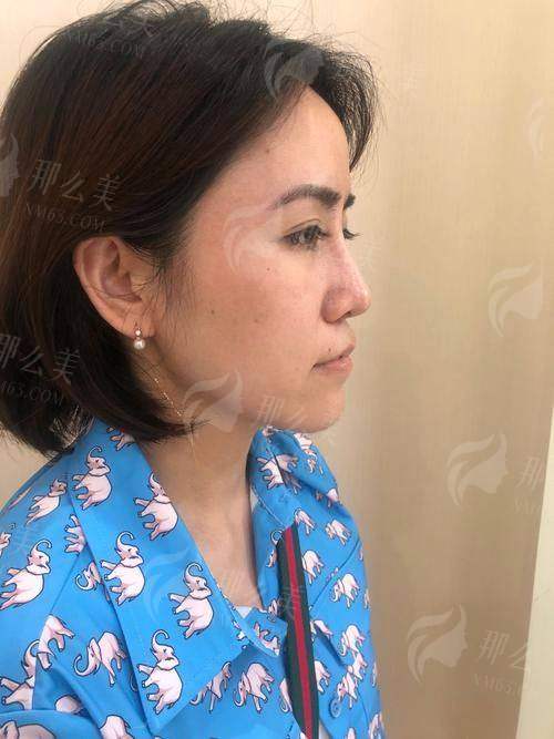 三、杭州清锴医疗李保锴院长隆鼻预约方式