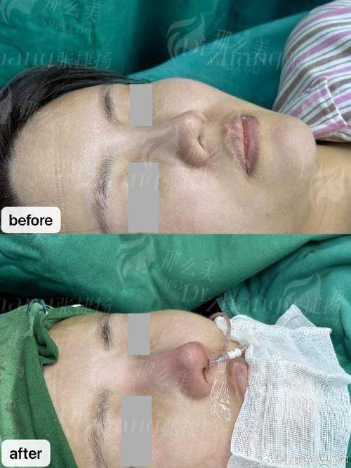 二、杭州清锴医疗李保锴院长隆鼻价格全解析