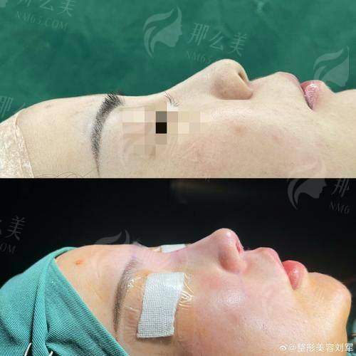 四、杭州清锴医疗李保锴院长隆鼻总结推荐