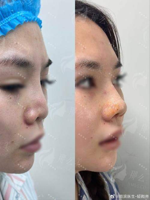 三、深圳宝丽李信锋鼻修复价格贵吗?同城对比告诉你