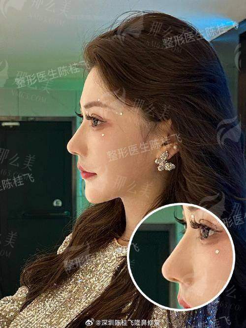 四、临汾佳美整形鼻综合怎么预约？