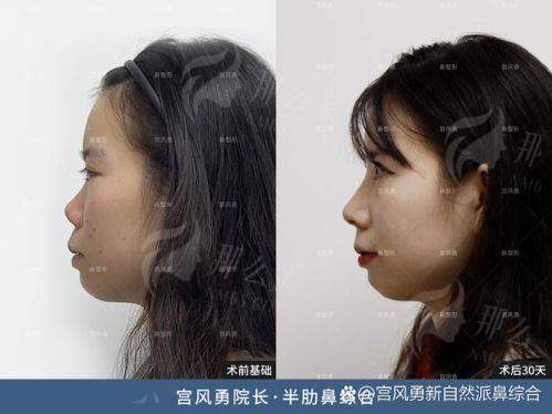 一、临汾佳美整形张鑫医生鼻综合技术强在哪？