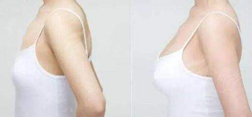 一、东莞美立方美容医院李志刚院长隆胸技术怎么样？