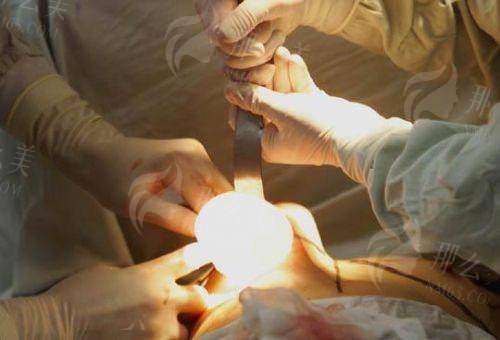 四、东莞美立方美容医院李志刚院长隆胸如何预约？