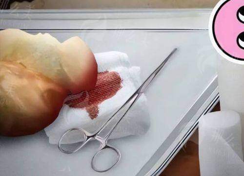 三、东莞美立方美容医院李志刚院长隆胸价格对比