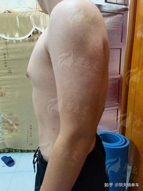 二、阴茎延长3-5cm真的可能吗？郑殿增医生详解原理