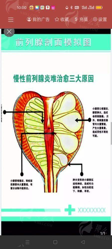 二、戴平博士的阴茎弯曲矫正技术强在哪?
