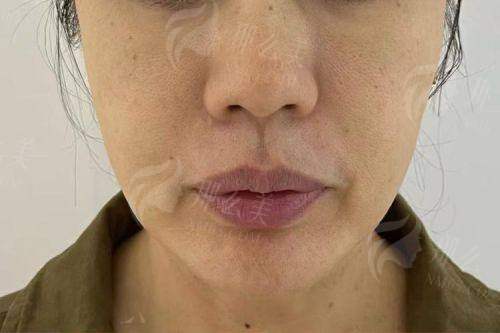 一、苏州沐兰清颜刘孟雨医生做幼态脸靠谱吗？