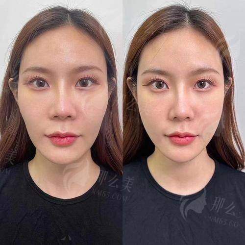 四、苏州沐兰清颜幼态脸打造怎么预约？术后要注意啥？