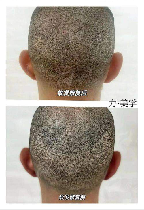 四、怎么预约青岛星尚植发张素英医生的发际线种植?