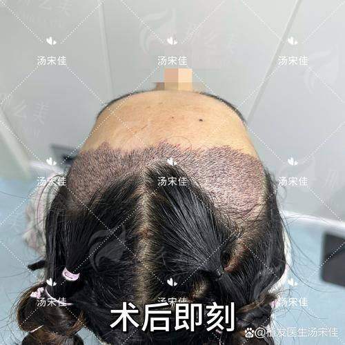三、青岛星尚植发张素英医生的发际线种植贵不贵?价格全解析
