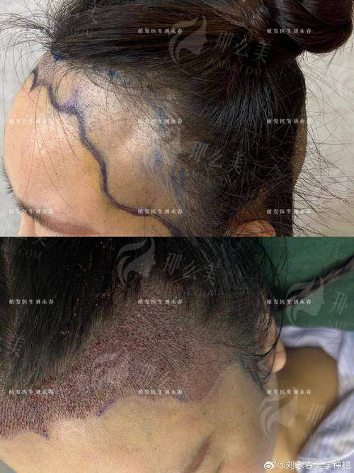 二、青岛星尚植发张素英医生的发际线种植成效有多绝?