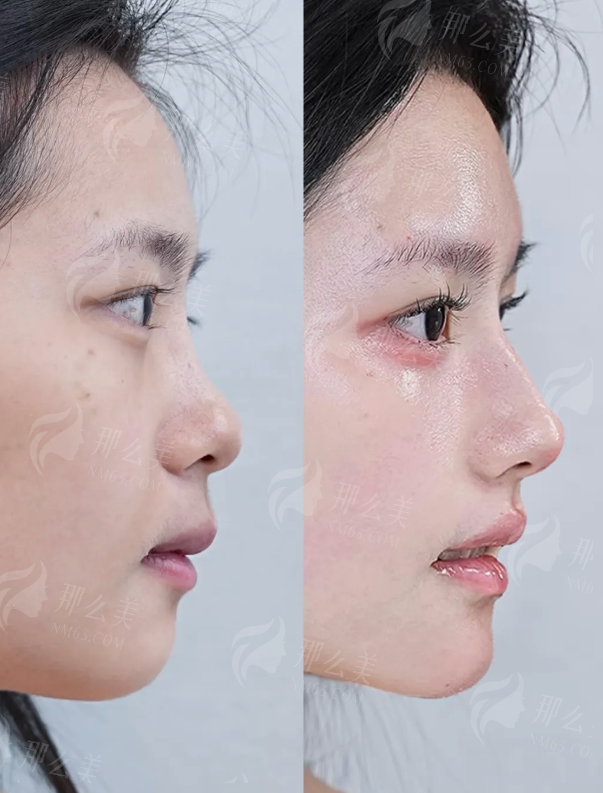 一、南京艺星陈天杰医生隆鼻技术强在哪?